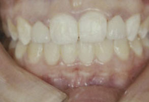 The image shows a person s mouth with teeth, displaying an upper denture and a lower set of teeth, possibly for dental implants or restoration purposes.