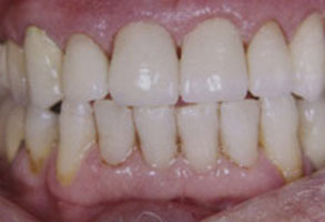 The image shows a close-up of a person s teeth with a focus on dental decay and discoloration, likely for educational or informational purposes related to oral health.