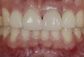 The image shows a close-up view of a person's teeth and upper lip, with the teeth appearing yellowed and possibly discolored.