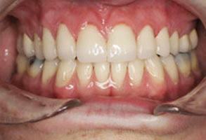 An image of a person's mouth with teeth showing, wearing a dental appliance for straightening teeth.
