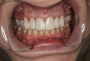 The image shows a close-up view of an individual with a wide open mouth displaying teeth, and wearing a clear dental appliance, possibly for orthodontic purposes.
