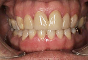 The image displays a close-up view of an open mouth with teeth showing, revealing a dental implant and possibly some orthodontic work in progress.