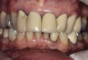 The image shows a close-up view of a set of teeth with visible staining and discoloration, which appear to be from a patient s mouth after dental treatment, possibly a cleaning or whitening procedure.
