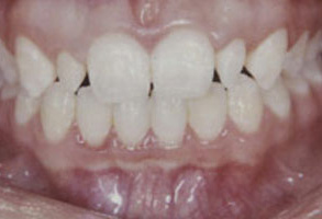 The image shows a close-up view of a person s mouth with teeth that appear yellowed and possibly stained, suggesting oral health issues such as discoloration or dental decay.