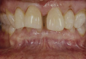The image shows a close-up of a person s teeth with yellowing, suggesting poor oral hygiene or advanced age, with an overlay of text that reads  ALT TAG.