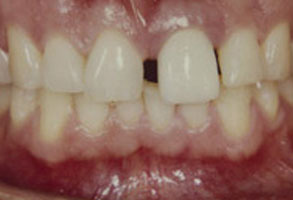 An image of a person's teeth with a focus on a tooth that has been replaced by an implant, showcasing a dental restoration.