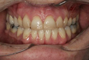The image shows a close-up view of a person's mouth with a set of teeth that appear to be in poor condition, possibly due to decay or other dental issues. The teeth are discolored and one tooth in particular appears to be missing, revealing the gum line. The mouth is open slightly, allowing a clear view of the teeth and the surrounding oral tissues.