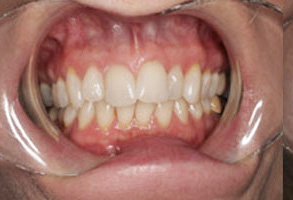 The image shows a close-up view of a person's mouth with visible dental work, including dentures and possibly orthodontic appliances, against a background that appears to be a medical setting.