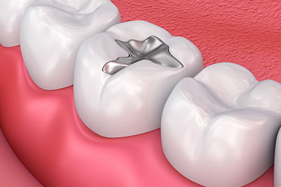 The image shows a close-up view of a dental implant with a metal screw emerging from a tooth, set against a backdrop of a human mouth with teeth and gums visible.