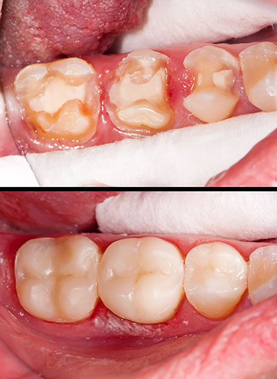 The image shows a close-up view of a person s mouth with a focus on dental issues, including teeth with yellowing and cavities, and a tongue that appears inflamed or damaged.