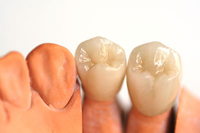 The image shows a set of artificial teeth and gums with a focus on dental implants, displayed against a white background.