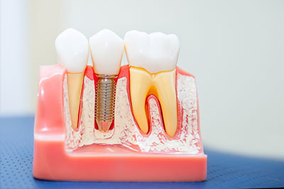 The image shows a model of a human mouth with artificial teeth, some of which have a screw visible from the front, indicating a dental implant demonstration.