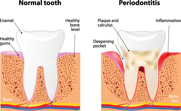 The image depicts a diagrammatic representation of normal tooth structure, a close-up of a periodontitis affected tooth, and a cross-sectional view of a tooth with bone loss.