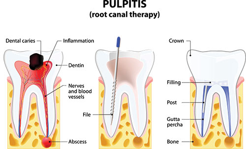 The image shows a detailed illustration of a pulpitis infection in a tooth, with labels pointing out various parts of the dental anatomy, including inflamed nerves, dentin, and a filling, along with a cross-sectional view of a tooth showing the pulp chamber and its inflammation.