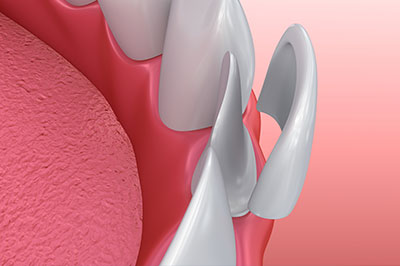 The image displays a close-up view of a dental implant with visible screws, set against a pink background that could represent soft tissue or gum.