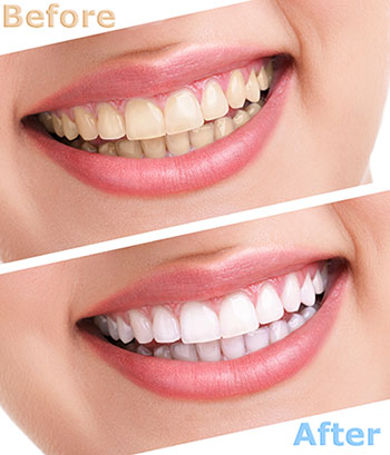 The image displays a before-and-after comparison of dental whitening treatments, showing a person s teeth transitioning from yellowish to white.