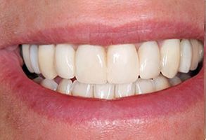 The image shows a close-up of a person s smiling face with clean teeth and a relaxed expression.