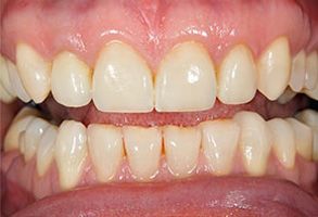 The image shows a close-up of a person s teeth with a focus on a yellowish discoloration, likely intended for dental care purposes or to illustrate the need for teeth whitening services.