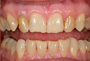 The image displays a close-up view of a person s teeth with significant discoloration and staining, showcasing a dental condition that requires professional attention.
